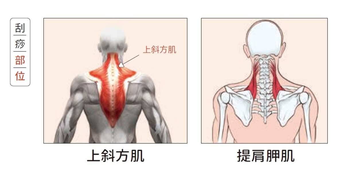上班族毛病「刮痧」來救！治療師示範：落枕、睡不好，刮「這些」部位有效