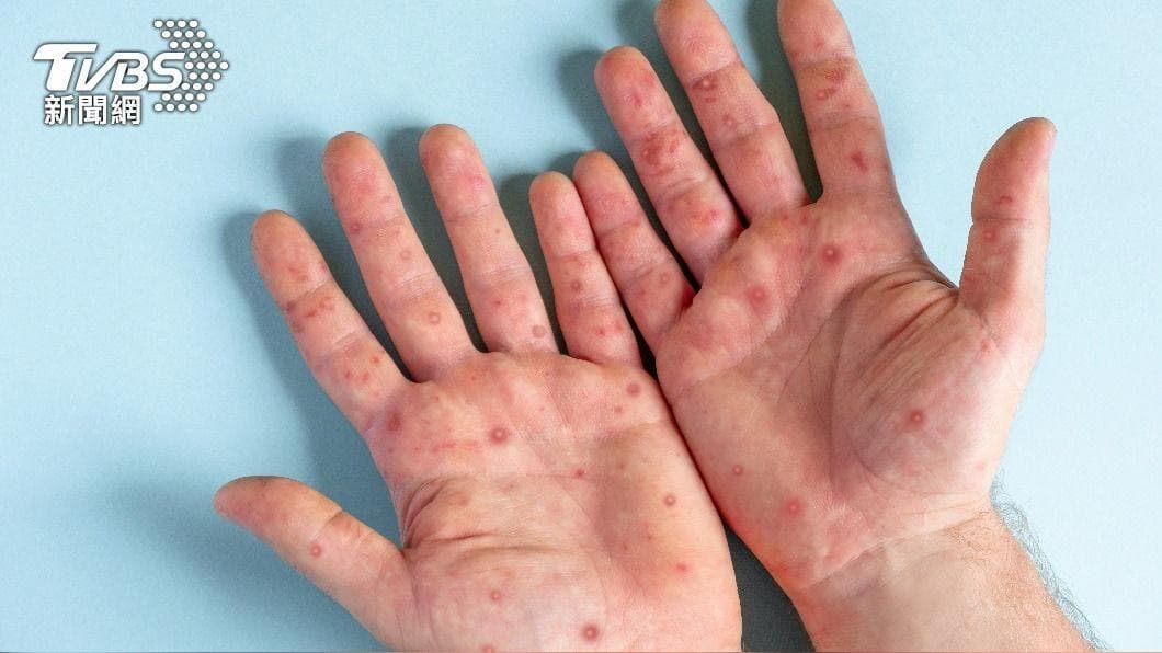 腸病毒常見的症狀為口腔、手掌、腳掌出現水泡、潰瘍。(示意圖/shutterstock達志影像) 腸病毒常見的症狀為口腔、手掌、腳掌出現水泡、潰瘍。(示意圖/shutterstock達志影像)