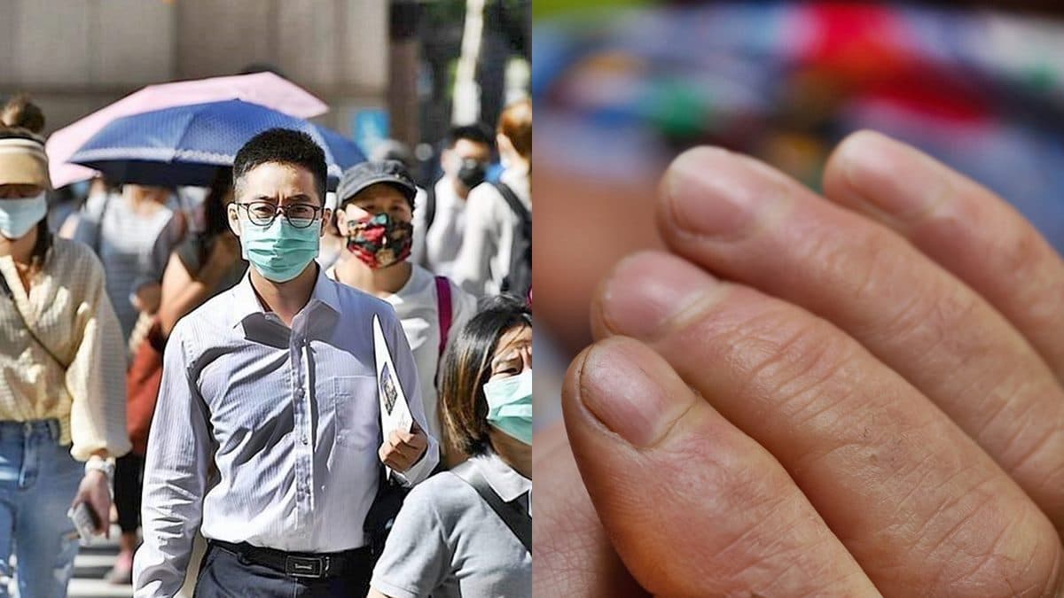 看「指甲」也能先快篩!新冠肺炎「指甲4症狀」,染疫過會出現白色條紋、指甲脫落特徵